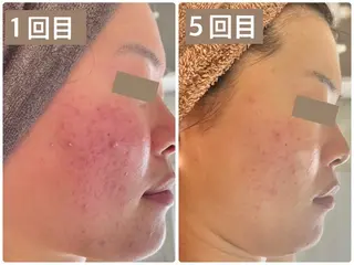 Sha.Lu.Lu.所属・本気の肌質改善/ ハーブピーリングのエステ・リラクイメージ