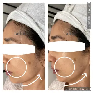 毛穴ケア・肌質改善 徳川のエステ・リラクイメージ