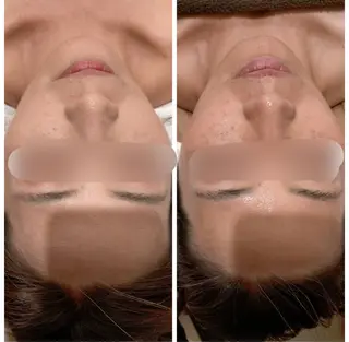 頭蓋骨小顔矯正 ハーブピーリングのエステ・リラクイメージ