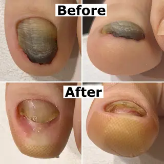 ネイル Mellow nail所属・巻爪無料モデル募集 ✨🦶MEGUMIのネイルデザイン