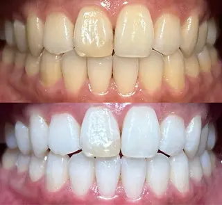 io teeth careのその他イメージ