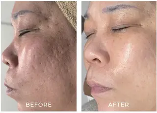 毛穴ケア くすみ肌 ハーブピーリングのエステ・リラクイメージ