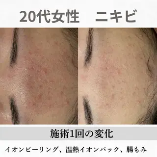 重度ニキビ専門🌷 ダウンタイムなしのエステ・リラクイメージ