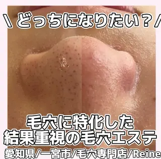 毛穴/シミ肝斑/脱毛 横山梨里のエステ・リラクイメージ