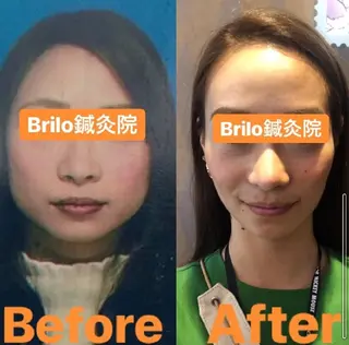 💙美容鍼💙美顔矯 正🧡Brilo🧡のエステ・リラクイメージ