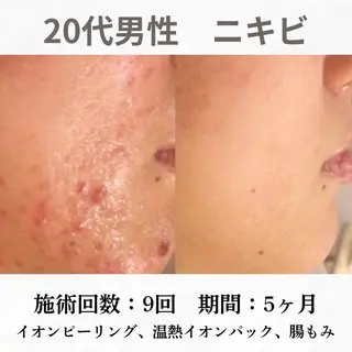 重度ニキビ専門🌷 ダウンタイムなしのエステ・リラクイメージ