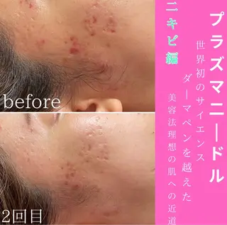 WAX・肌質改善・毛 穴洗浄/林愛真のエステ・リラクイメージ