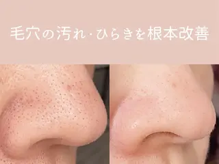 小顔/毛穴/ニキビ salon bealのエステ・リラクイメージ