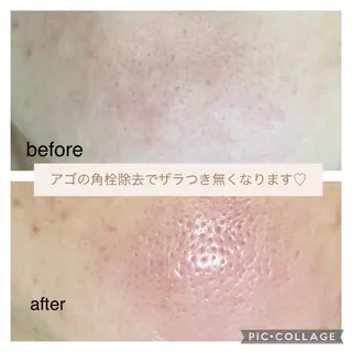 毛穴ケア・肌質改善 徳川のエステ・リラクイメージ