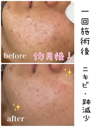 OUKA脱毛 毛穴ケアフェイシャルのエステ・リラクイメージ