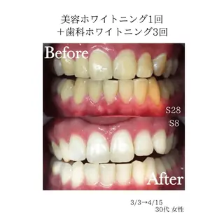 東区香椎歯のセルフホ ワイトニングGLOWのその他イメージ