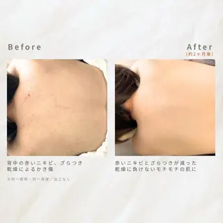 繰り返すニキビ・毛穴 ✨つくば肌質改善専門のエステ・リラクイメージ