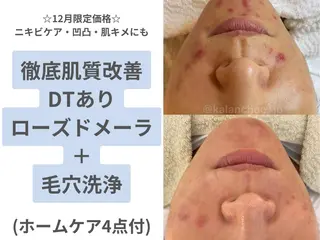 肌質改善 KALANCHOEのエステ・リラクイメージ