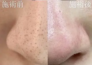 毛穴/毛穴洗浄専門 エミルカ船橋のエステ・リラクイメージ