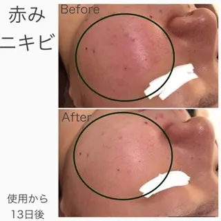 3か月で肌革命👼 ニキビ専門店💫のエステ・リラクイメージ