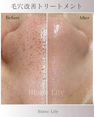 肌質改善サロンBlanc Lily【ブランリリー】所属・ピーリング専門サロン サロンブランリリーのエステ・リラクイメージ
