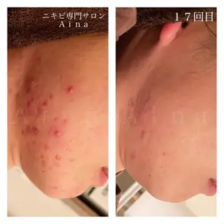 ロング カラー パーマ ヘアアレンジ メンズ キッズ ネイル マツエク・マツパ ニキビ跡専門サロン Ainaのエステ・リラクイメージ