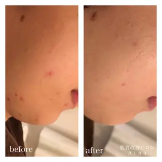 ショート カラー パーマ ヘアアレンジ メンズ キッズ ネイル マツエク・マツパ ニキビ跡専門サロン Ainaのエステ・リラクイメージ