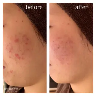 セミロング カラー パーマ ヘアアレンジ メンズ キッズ ネイル マツエク・マツパ ニキビ跡専門サロン Ainaのエステ・リラクイメージ