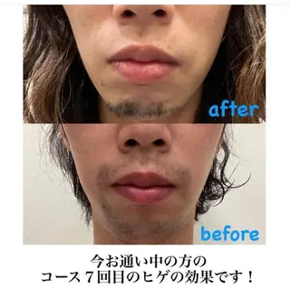 脱毛＆フェイシャル/ Rappore;増田のエステ・リラクイメージ