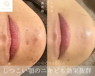 ハーブピーリング専門 サロンドレナ　白藤のエステ・リラクイメージ