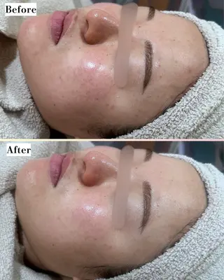 |ピーリング・毛穴| soina神楽坂のエステ・リラクイメージ