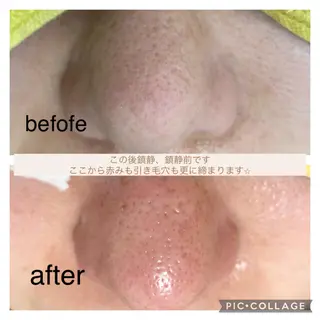 毛穴ケア・肌質改善 徳川のエステ・リラクイメージ