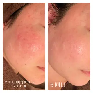 セミロング カラー パーマ ヘアアレンジ メンズ キッズ ネイル マツエク・マツパ ニキビ跡専門サロン Ainaのエステ・リラクイメージ