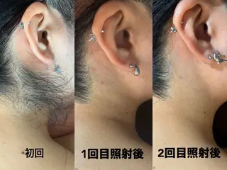 ワックス脱毛/光脱毛 🎀新宿駅徒歩5分のエステ・リラクイメージ