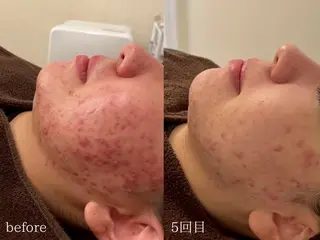 eto.所属・肌質改善サロンeto ニキビ・ニキビ跡のエステ・リラクイメージ