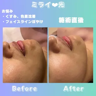 肌質改善/都度脱毛 Mahinaのエステ・リラクイメージ