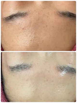 Chalon所属・REVI取扱・肌悩み 毛穴Chalonのエステ・リラクイメージ