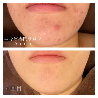 セミロング カラー パーマ ヘアアレンジ メンズ キッズ ネイル マツエク・マツパ ニキビ跡専門サロン Ainaのエステ・リラクイメージ