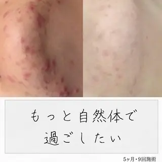 ニキビ経験者が施術 する専門サロン🌻のエステ・リラクイメージ