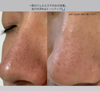 毛穴開き黒ずみ ニキビ特化💆‍♀️のエステ・リラクイメージ