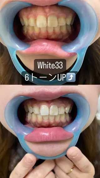 メンズ セルフホワイトニング White33大名のその他イメージ