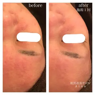 セミロング ヘアアレンジ キッズ ネイル マツエク・マツパ ニキビ跡専門サロン Ainaのエステ・リラクイメージ