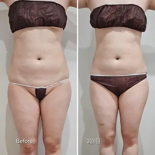 脂肪冷却 & 脱毛 AYUMIのその他イメージ