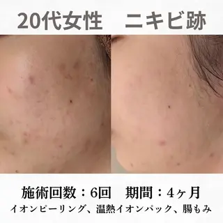 重度ニキビ専門🌷 ダウンタイムなしのエステ・リラクイメージ