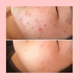 セミロング カラー パーマ ヘアアレンジ メンズ キッズ ネイル マツエク・マツパ アイブロウ 3か月で肌革命👼 ニキビ専門店💫のエステ・リラクイメージ