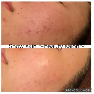 ニキビ/肌質改善専門 Snow skinのエステ・リラクイメージ