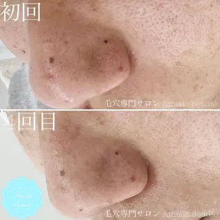 メンズ 毛穴ケア専門サロン アメリオボーテのその他イメージ