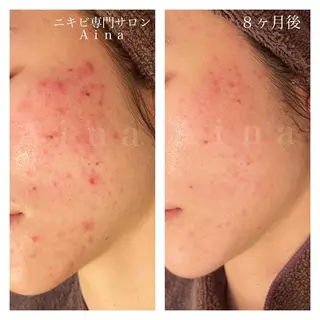 ロング カラー パーマ ヘアアレンジ メンズ キッズ ネイル マツエク・マツパ アイブロウ ニキビ跡専門サロン Ainaのエステ・リラクイメージ