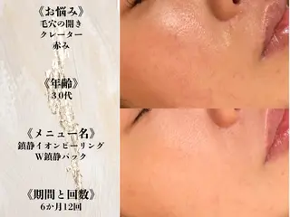 ニキビ跡改善専門🔥 医療にはできない改善のエステ・リラクイメージ