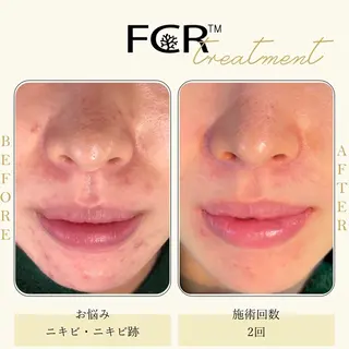 ニキビ改善シャルム ココハーブピーリングのエステ・リラクイメージ