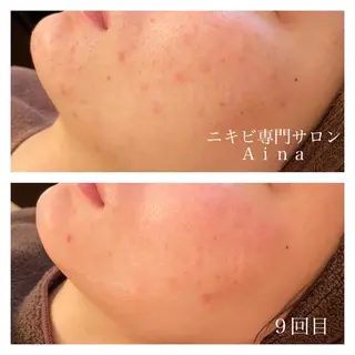 ミディアム カラー パーマ ヘアアレンジ メンズ キッズ ネイル マツエク・マツパ ニキビ跡専門サロン Ainaのエステ・リラクイメージ
