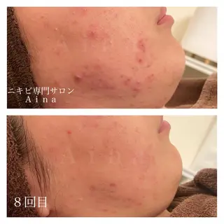 セミロング カラー パーマ ヘアアレンジ メンズ キッズ ネイル マツエク・マツパ ニキビ跡専門サロン Ainaのエステ・リラクイメージ