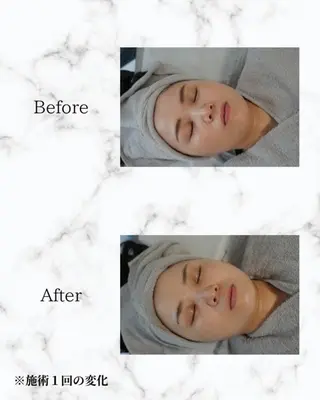 ハーブピーリング🌿 REVI/Ayanoのエステ・リラクイメージ