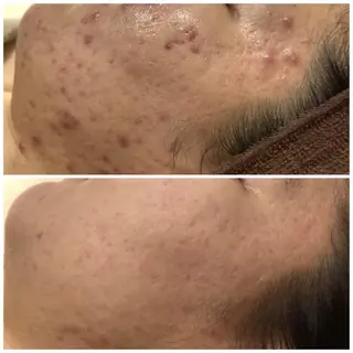 セミロング カラー パーマ ヘアアレンジ メンズ キッズ ネイル マツエク・マツパ アイブロウ 3か月で肌革命👼 ニキビ専門店💫のエステ・リラクイメージ