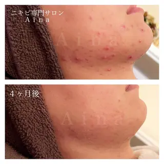 セミロング パーマ ヘアアレンジ メンズ キッズ ネイル マツエク・マツパ アイブロウ ニキビ跡専門サロン Ainaのエステ・リラクイメージ